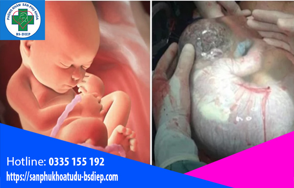 bi-du-oi-1 B5i dư ối