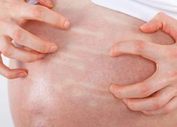 Bị ngứa khi mang thai tháng cuối