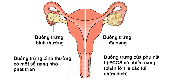 buong-trung-da-nang Buồng trứng đa nang