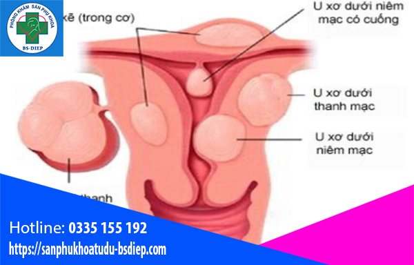 cac-loai-nhan-xo-tu-cung-1 Nhân xơ tử cung