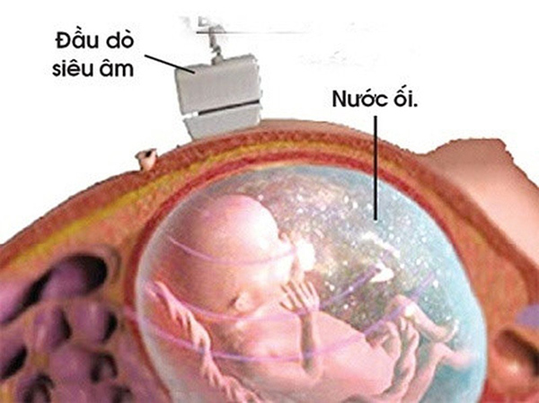 choc-oi-co-nguy-hiem-khong Chọc ối có nguy hiểm không