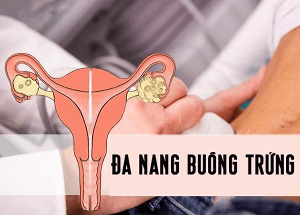 da-nang-buong-trung-gay-vo-sinh Đa nang buồng trứng gây vô sinh