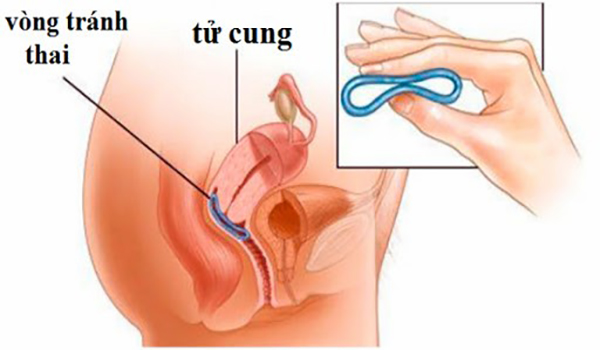 dat-vong-tranh-thai-khi-nao-o-dau Đặt vòng tránh thái khi nào ở đâu