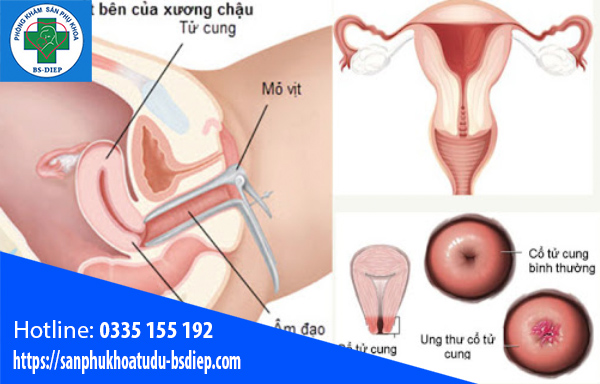 dau-hieu-nhan-biet-benhtu-cung Mô phỏng dấu hiệu nhận biết bệnh cổ tử cung