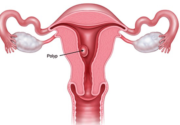 dau-hieu-polyp-co-tu-cung Dấu hiệu polyp cổ tử cung