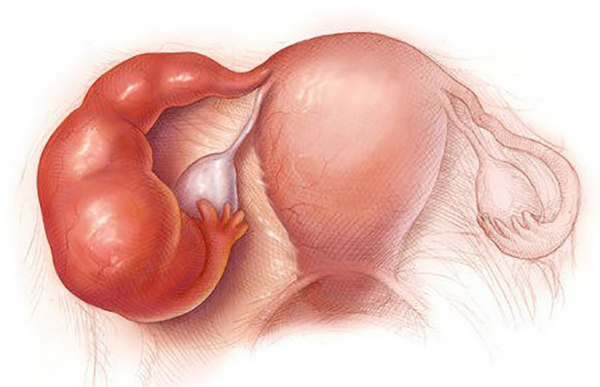 Dấu hiệu ứ dịch vòi trứng