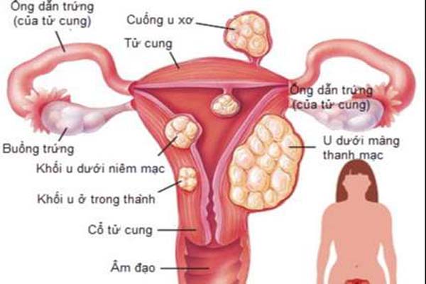 dau-hieu-u-nang-tu-cung Unang tử cung