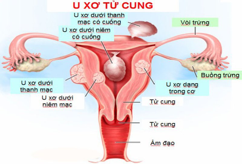 Dấu hiệu u xơ tử cung