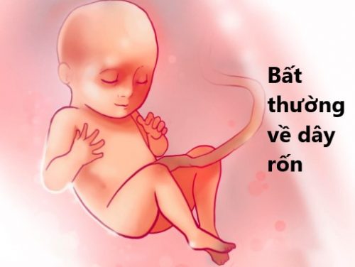 Day rốn bất thường