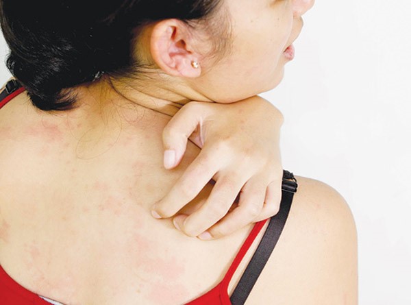 di-ung Dị ứng là nguyên nhân chủ yếu khiến mẹ bị nổi mề đay sau sinh