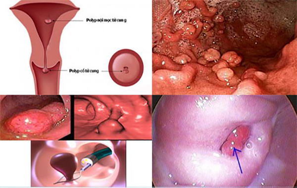 dieu-tri-po3byp-co-tu-cung Điều trị polyp cổ tử cung