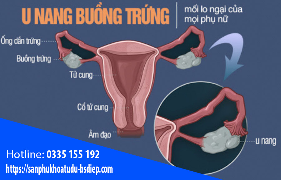 dieu-tri-u-nang-buong-trung-1 Điều trị u nang buồng trứng
