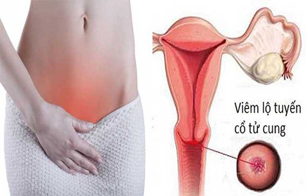 Điều trị viêm lộ tuyến cổ tử cung