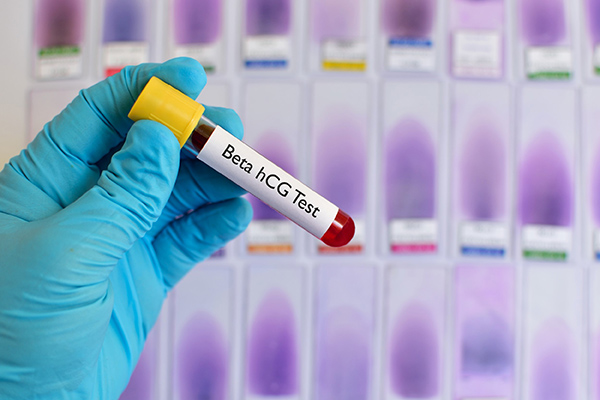 dinh-luong-beta-hcg-mau Dịnh lượng beta-hCG máu