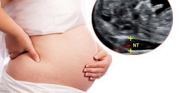 do-mo-da-gay-1_5 Độ mờ da gáy 1.5 khi thai 12 tuần là bình thường nên mẹ bầu không cần lo lắng