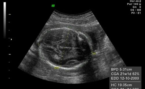 duong-kinh-luong-dinh-thai-37-tuan Đường kính lưỡng đỉnh thai 37 tuần