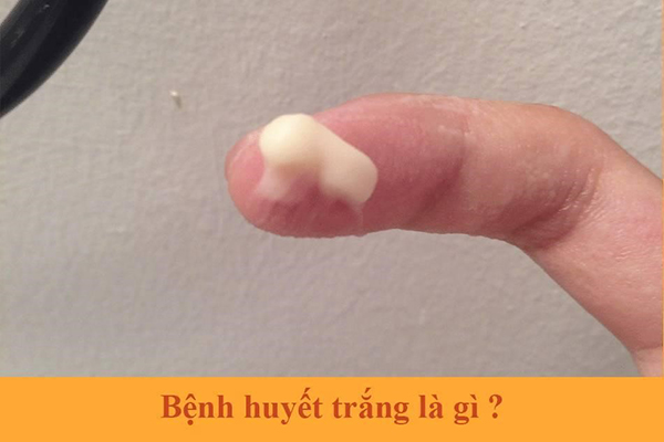 huyet-trang-am-dao Huyết trắng âm đạo