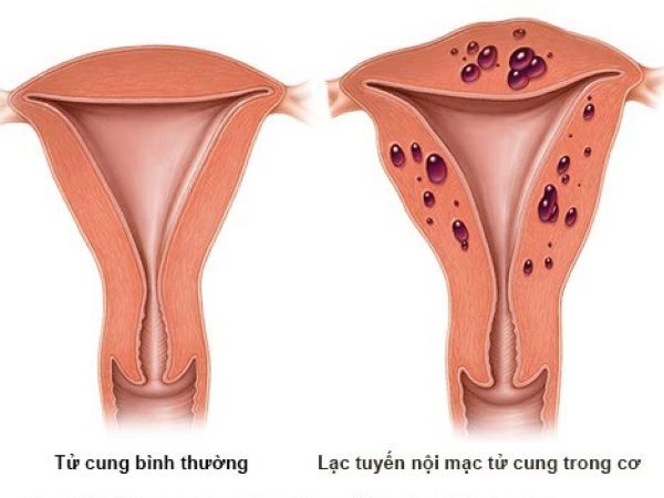 Lạc nội mạc trong cơ tử cung