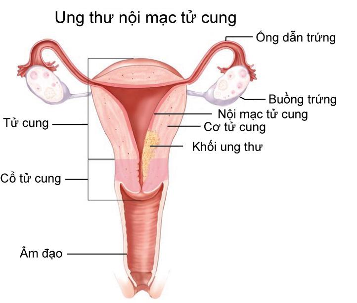 Lạc nội mạc tử cung