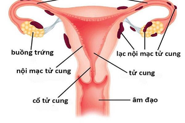 lac-noi-mac-tu-cung-co-thai-khong Lạc nội mạc tử cung có thai được không