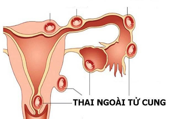 mang-thai-ngoai-tu-cung-3 Mang thai ngoài tử cung
