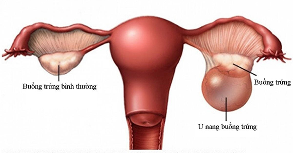 Biểu hiễn u nang buồng trứng