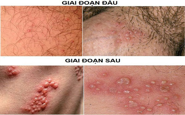 Mụn rộp sinh dục