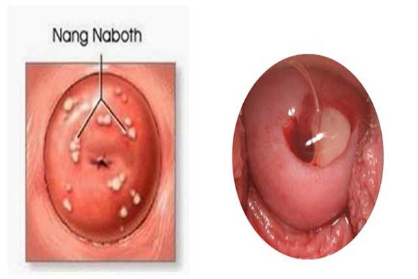 nang-naboth-co-tu-cung Nang Naboth chủ yếu ảnh hưởng tới khả năng mang thai và cảm xúc thăng hoa khi quan hệ tình dục