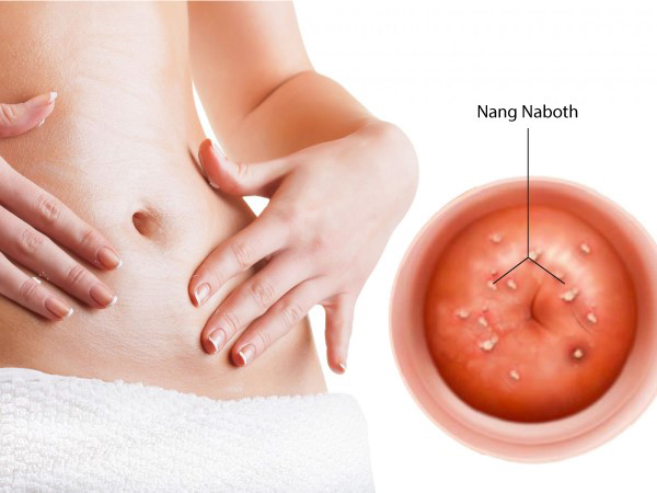 nang-naboth Nang naboth cổ tử cung