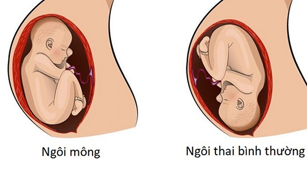 ngoi-thai Ngôi thai