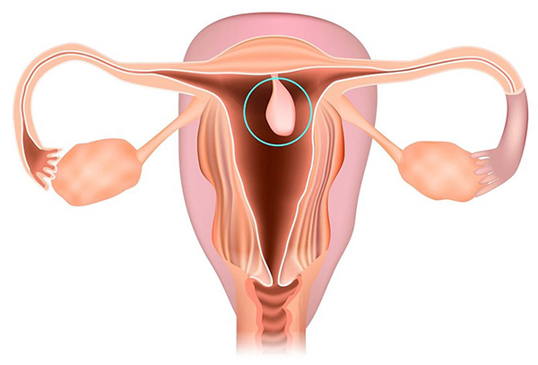 nguyen-nhan-gay-polyp-co-tu-cung Có nhiều nguyên nhân khác nhau gây polyp cổ tử cung