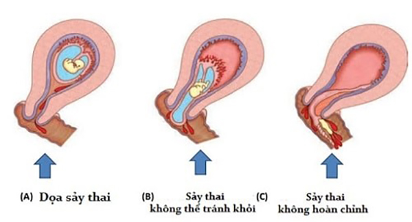 nguyen-nhan-gay-ra-hien-tuong-say-thai Nguyên nhân gây ra hiện tượng sảy thai