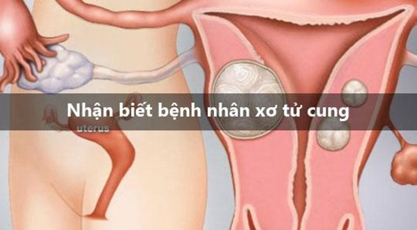 Nhân xơ tử cung