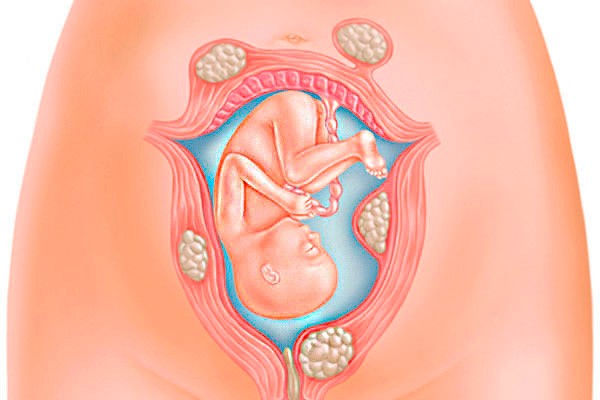 nhan-xo-tu-cung-co-nguy-hiem-khong Nhân xơ tử cung có nguy hiểm không