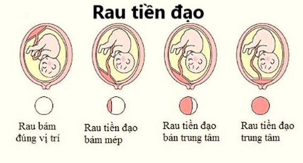 nhau-tien-dao-co-nguy-hiem-khong Nhau tiền đạo là tình trạng nguy hiểm mà bà bầu cần lưu ý