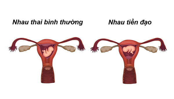 nhau-tien-dao Nhau tiền đạo