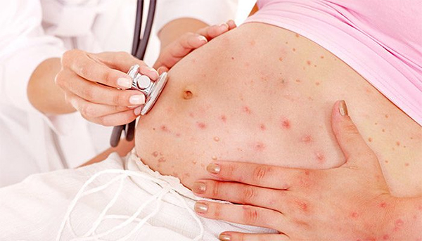 nhiem-rubella-khi-mang-thai Nhiễm Rubella khi mang thai