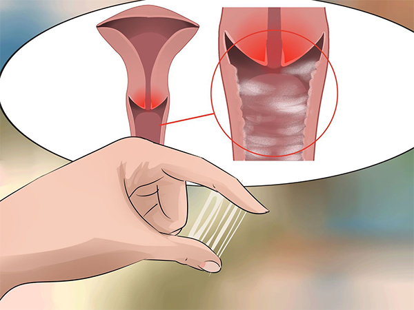nieu-dao-ra-huyet-trang Niệu đạo ra huyết trắng
