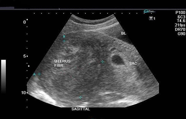 phathien-u-xo-tu-cung-qua-sieu-am-dau-do Phát hiện u xơ tử cung qua siêu âm đầu dò