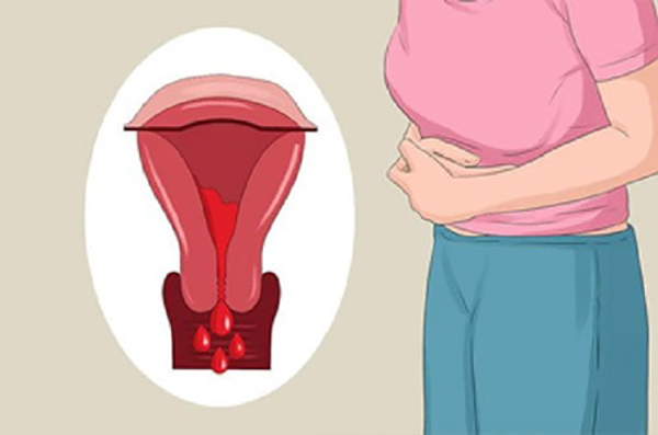 rong-kinh-rong-huyet Rong kinh rong huyết có thể xuất hiện ở nhiều độ tuổi khác nhau