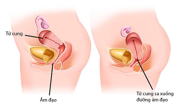 sa-co-tu-cung-sau-sinh Sa cổ tử cung sau sinh