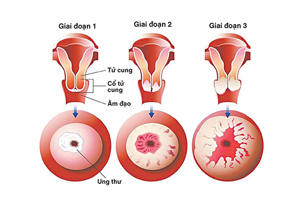 sang-loc-ung-thu-co-tu-cung-1 Ung thư cổ tử cung