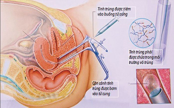 sau-bom-tinh-trung-co-nen-quan-he Sau khi bơm tinh trùng có nên quan hệ