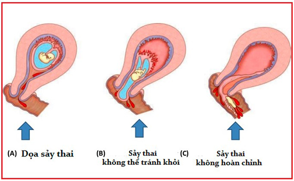 say-thai-la-gi Sảy thai là gì