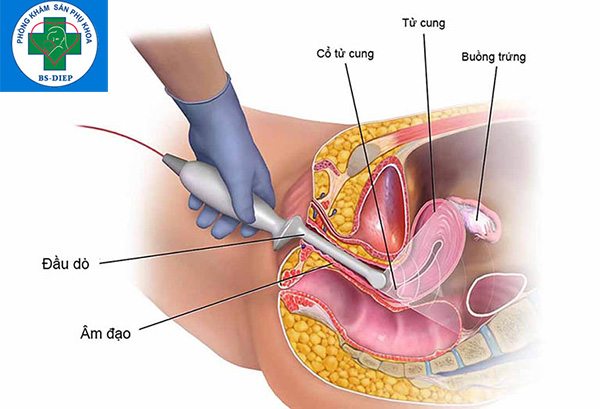 Siêu âm cổ tử cung
