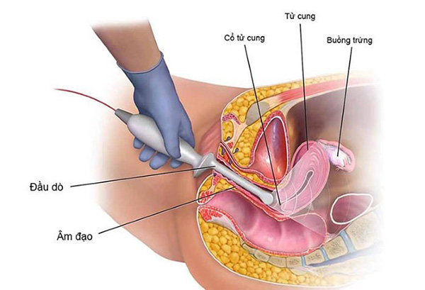 sieu-am-dau-do-am-dao Siêu âm đầu dò âm đạo
