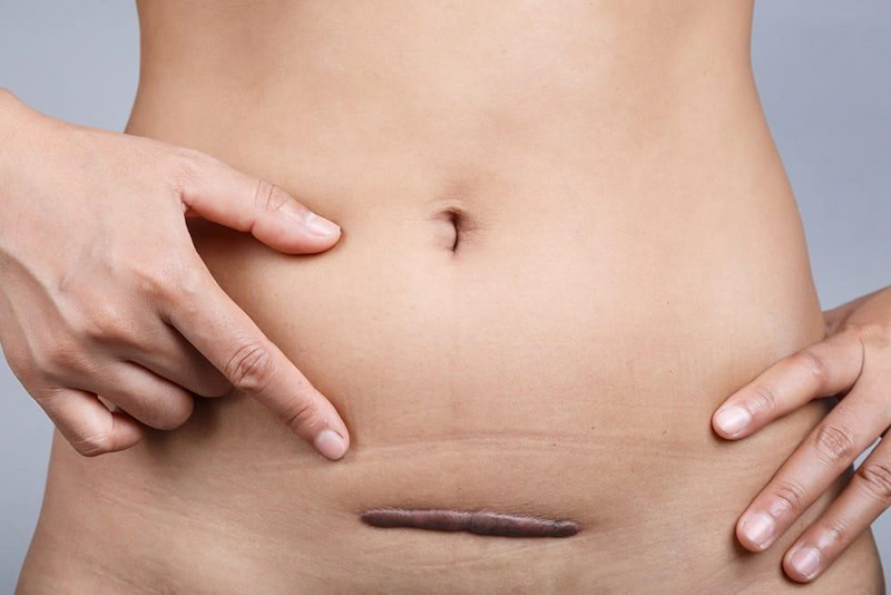 Sinh mổ 1 năm có bầu lại được không?