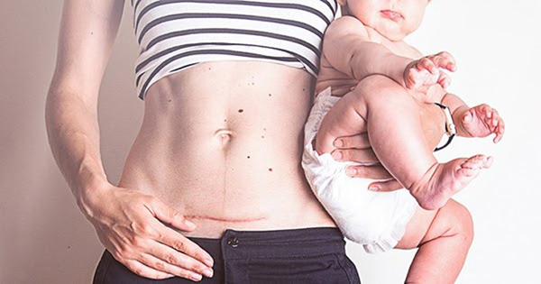 Sinh mổ lần 1 lần 2 sinh thường được không