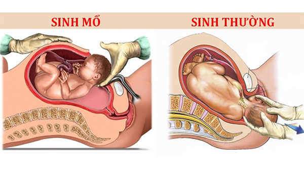 sinh-thuong-hay-sinh-mo Sinh thường hay sinh mổ