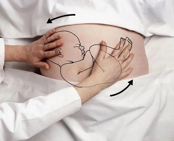 tac-dong-ben-ngoai Bác sĩ có thể tác động từ bên ngoài để xoay chuyển hướng nằm của bé.